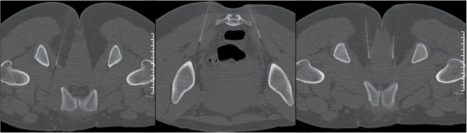 Intralevator Injection Of Botulinum Toxin For The Treatment Of Hypertonic Pelvic Floor Muscle Dysfunction And Vestibulodynia Goldstein 2011 The Journal Of Sexual Medicine Wiley Online Library